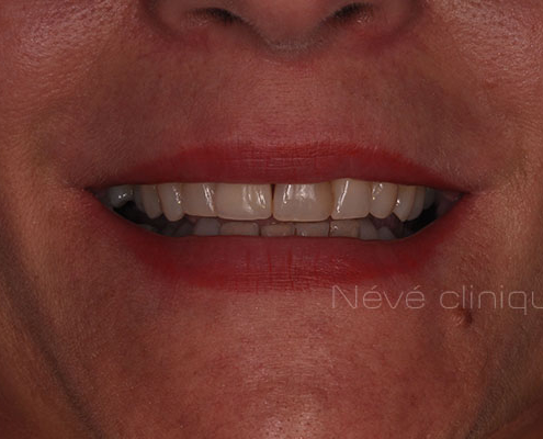 dental implant - Geneva