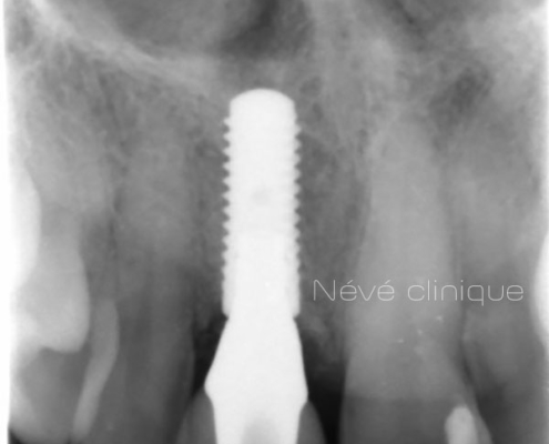 dental implant - Geneva