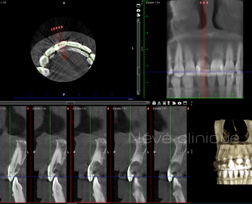 Implants dentaires - Genève