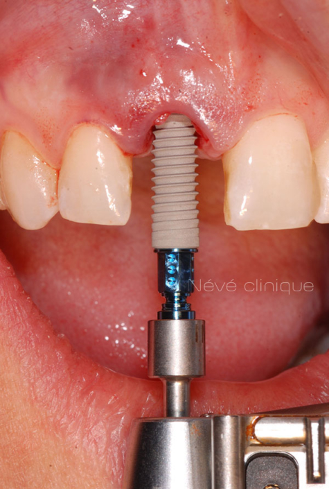 dental implant - Geneva