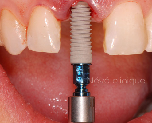 dental implant - Geneva