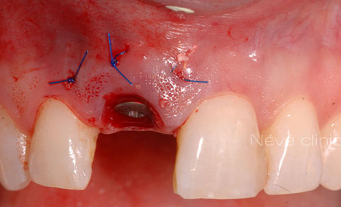 dental implant - Geneva