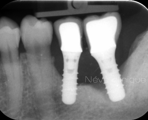 Bone graft - Geneva