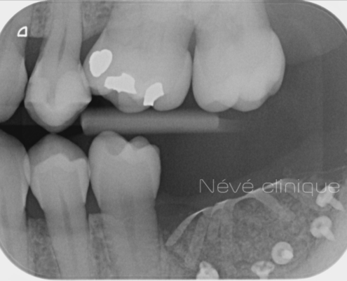 Bone graft - Geneva