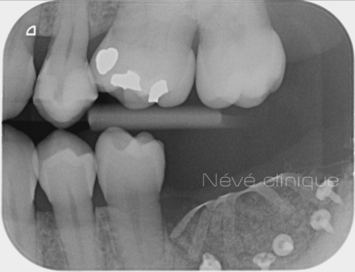 Bone graft - Geneva