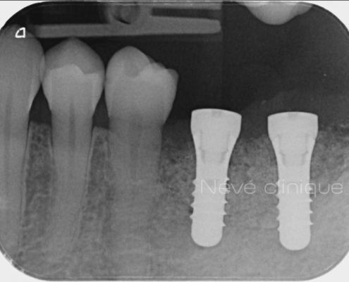 Bone graft - Geneva