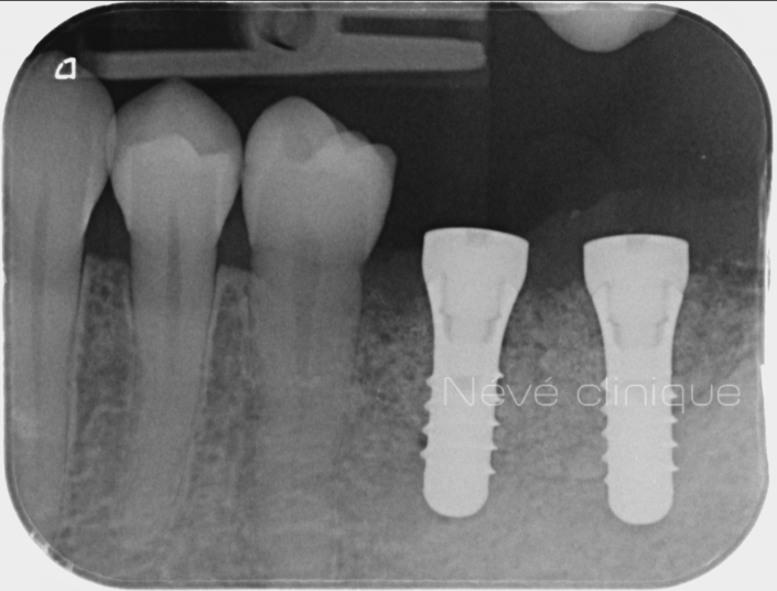 Bone graft - Geneva