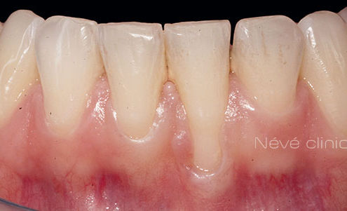 Gingival graft -Geneva