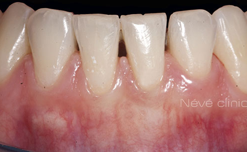 Gingival graft -Geneva