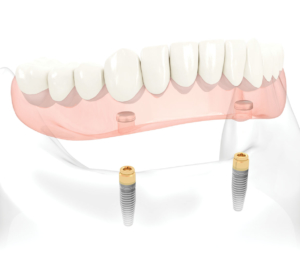 dental implant - Geneva