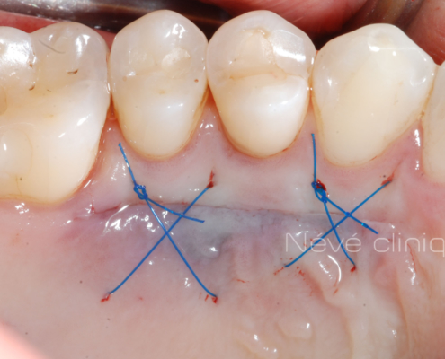 Gingival graft -Geneva