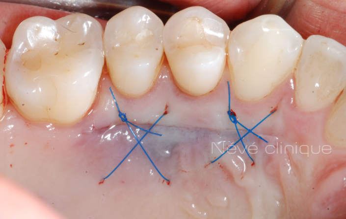 Gingival graft -Geneva