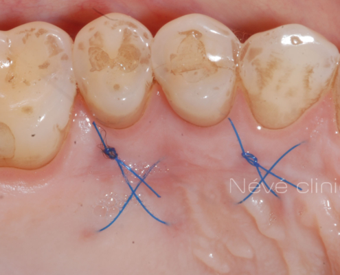 Gingival graft -Geneva