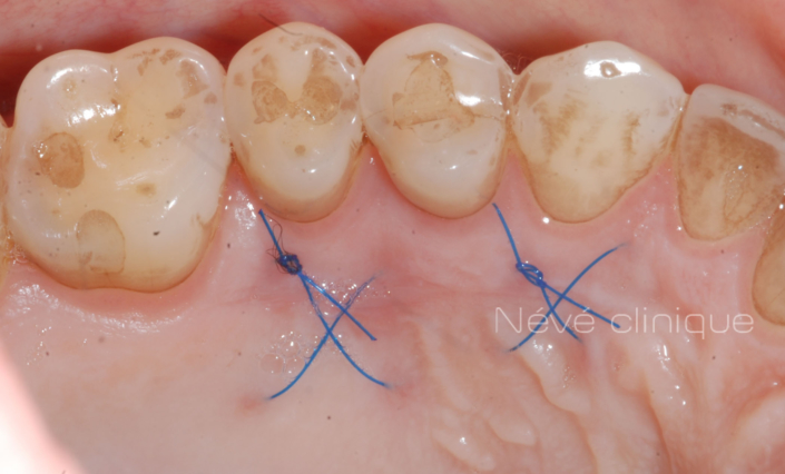 Gingival graft -Geneva