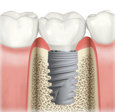 Implants dentaires - Genève