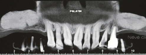 Bone graft - Geneva