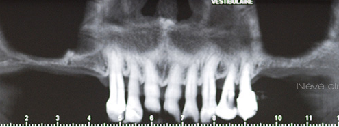 Bone graft - Geneva