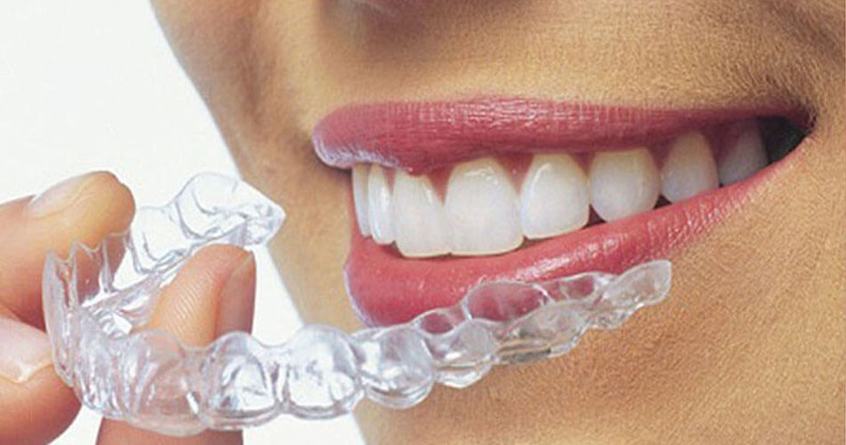 Invisalign Genève