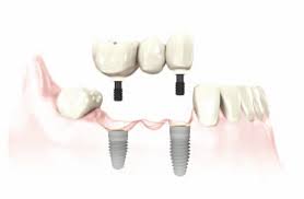 dental implant - Geneva