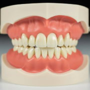 Carie au collet : pourquoi la récession gingivale en fait une cible privilégiée