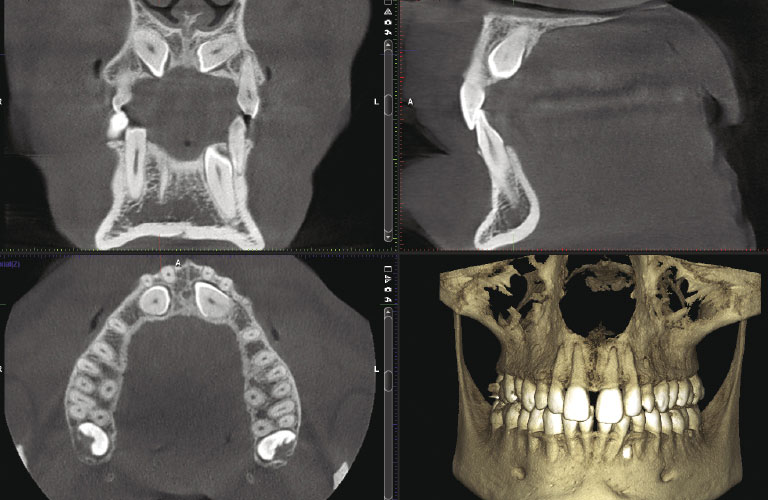 dental implant - Geneva