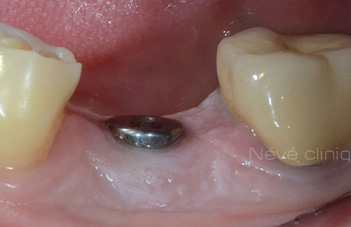 dental implant - Geneva