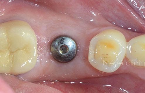 dental implant - Geneva