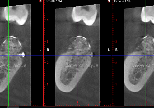 Bone graft - Geneva