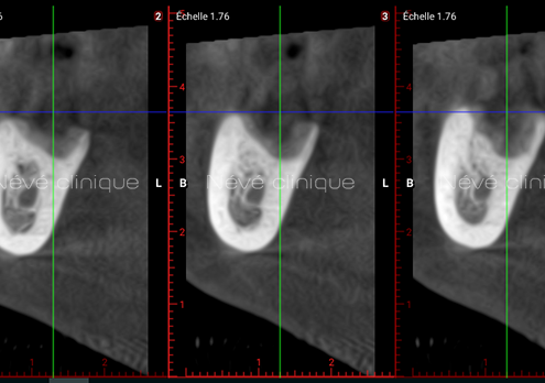 Bone graft - Geneva