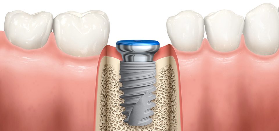 Implants dentaires - Genève