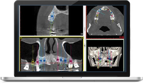 dental implant - Geneva