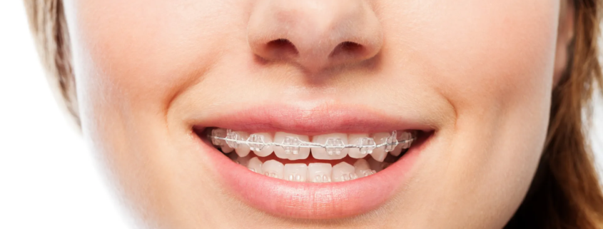 sourire d'une femme avec un appareil dentaire