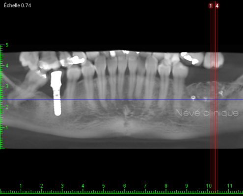 Bone graft - Geneva