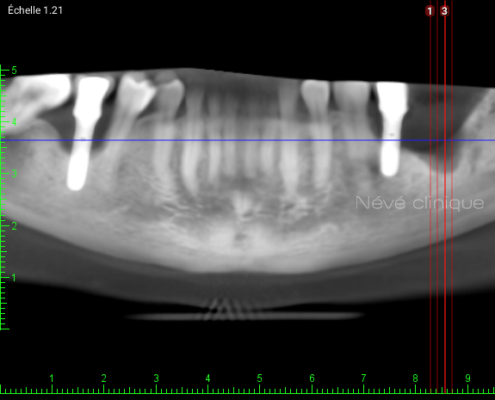 Bone graft - Geneva