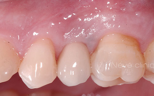 dental implant - Geneva