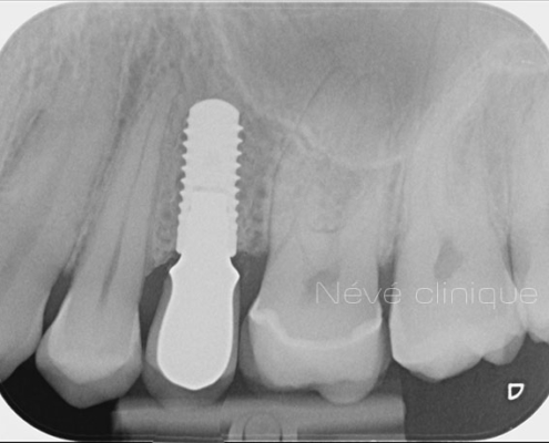 dental implant - Geneva