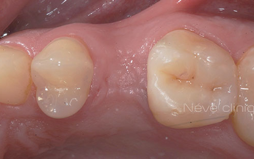 dental implant - Geneva