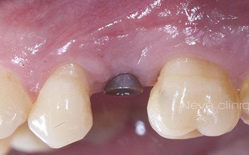 dental implant - Geneva