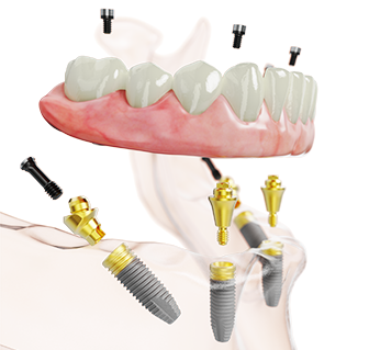 dental implant - Geneva