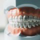 Sourire gingival : quel traitement selon la cause ? Le guide d’un cabinet à Genève